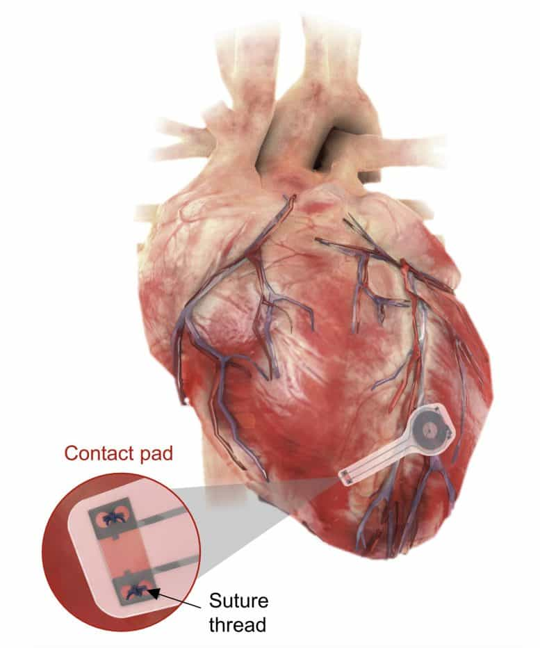 可完全吸收的心臟起搏器問世